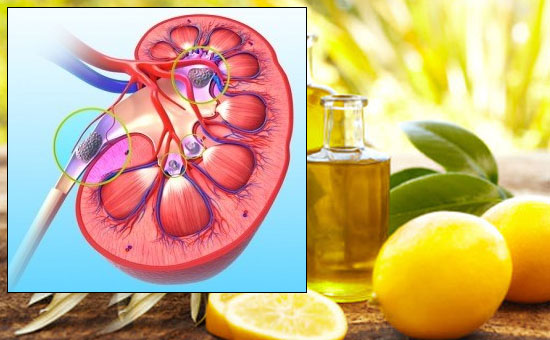 Natural Remedies for Kidney Stones 