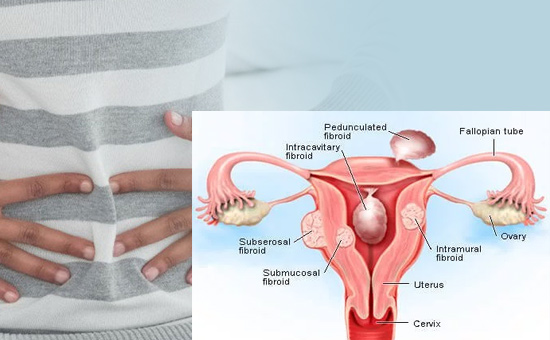 Ayurvedic intervention in the management of uterine fibroids - A Case series